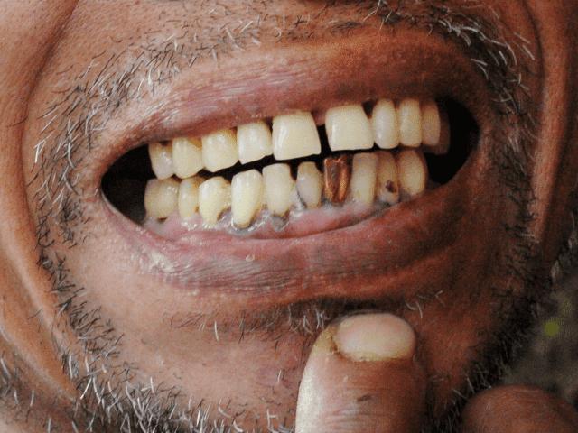 Prancūzija: afrikiečiui nebeteks džiaugtis auksiniais dantimis, Paryžiaus priemiestyje plėšikai juos išlupo